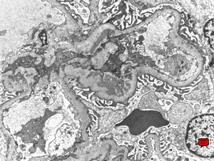 F,19y. | IgA nephropathy